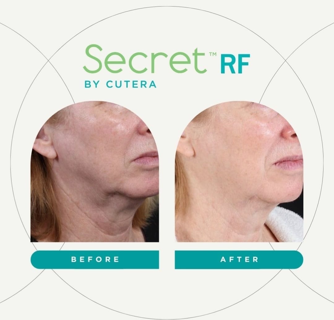 Cutera Secret RF