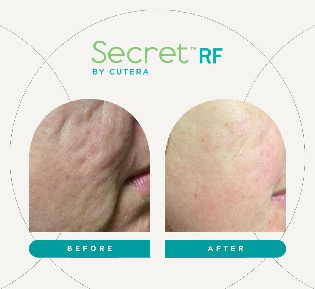 Cutera Secret RF