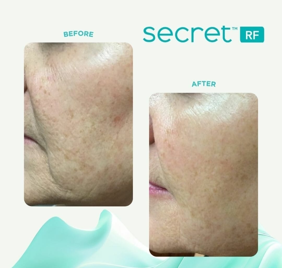 Cutera Secret RF