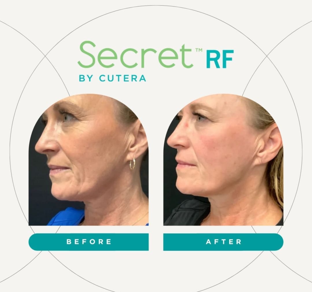 Cutera Secret RF
