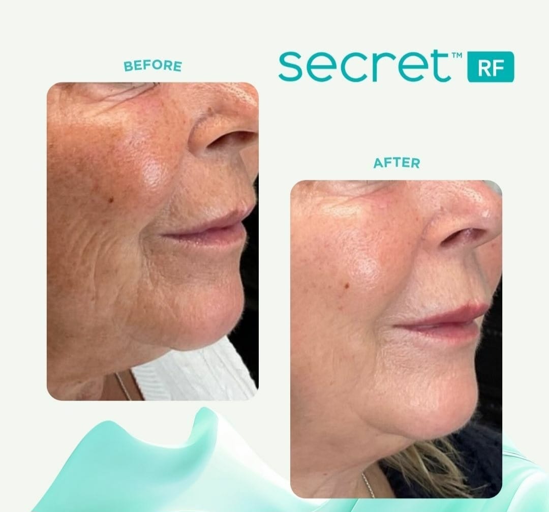 Cutera Secret RF