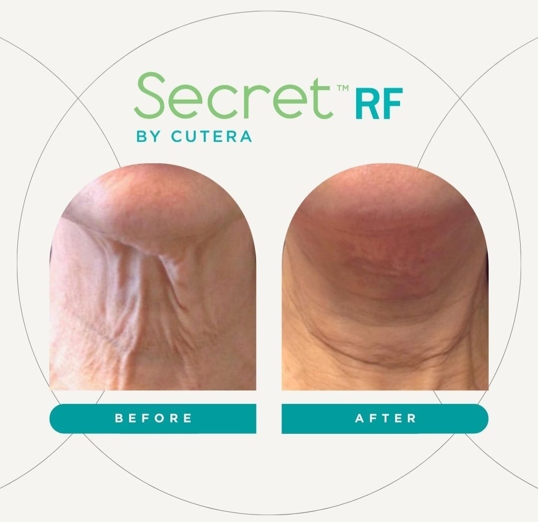 Cutera Secret RF