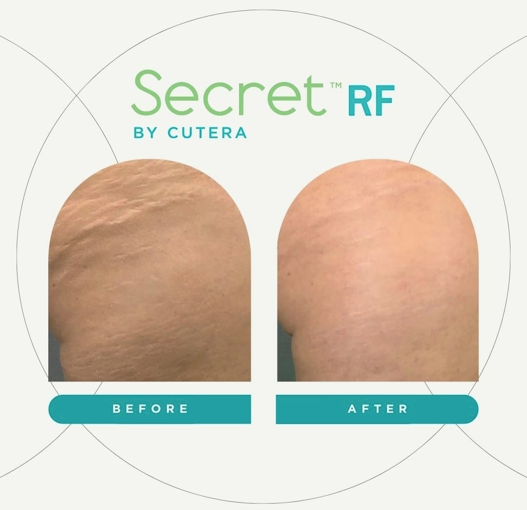 Cutera Secret RF