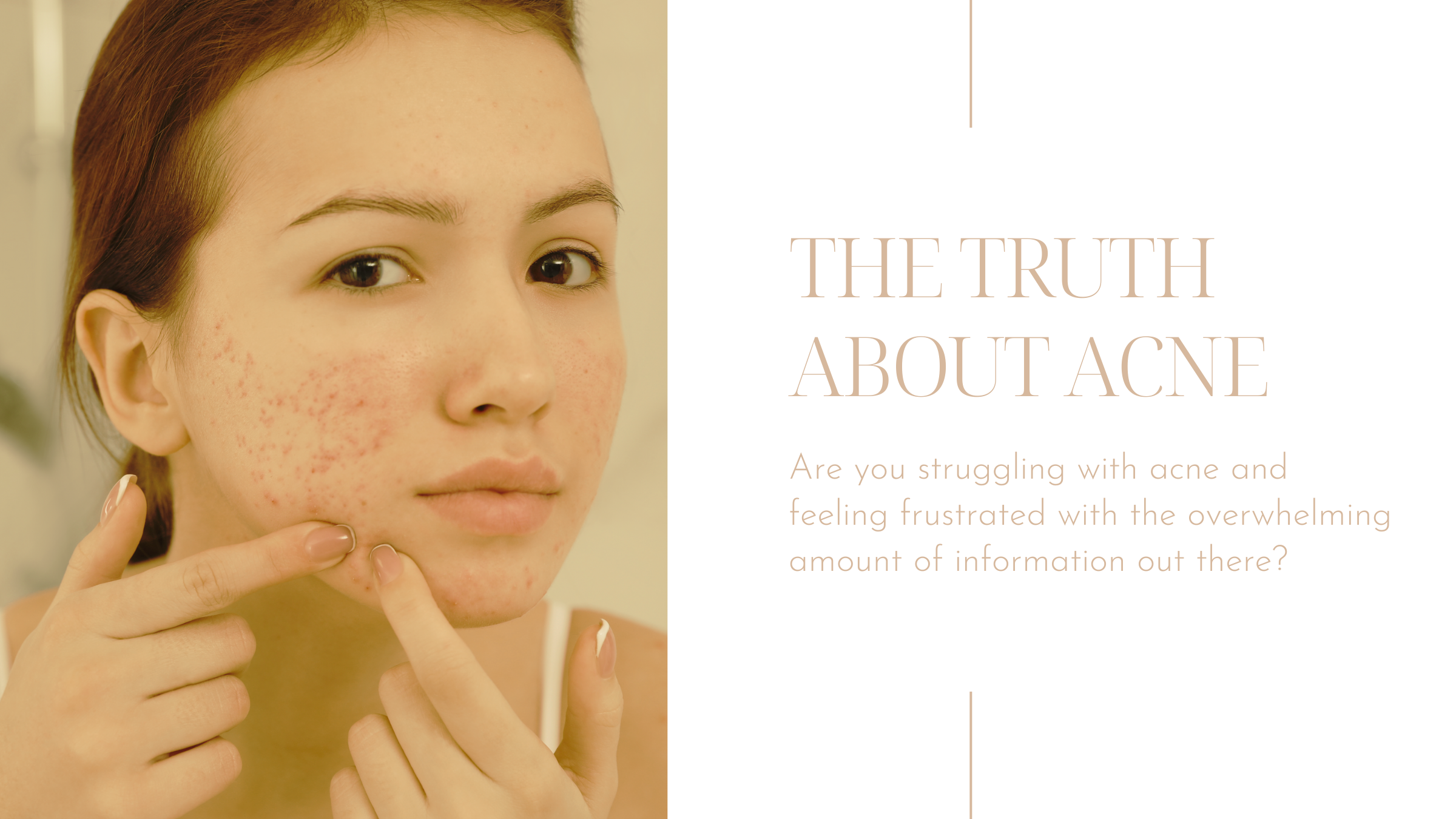 The Truth About Acne